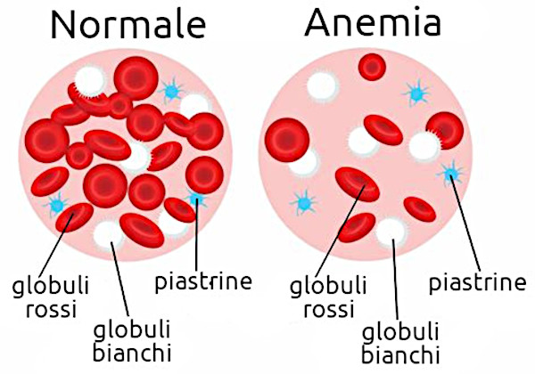 Anemia:  diagnosticata con smartphone grazie ad una App